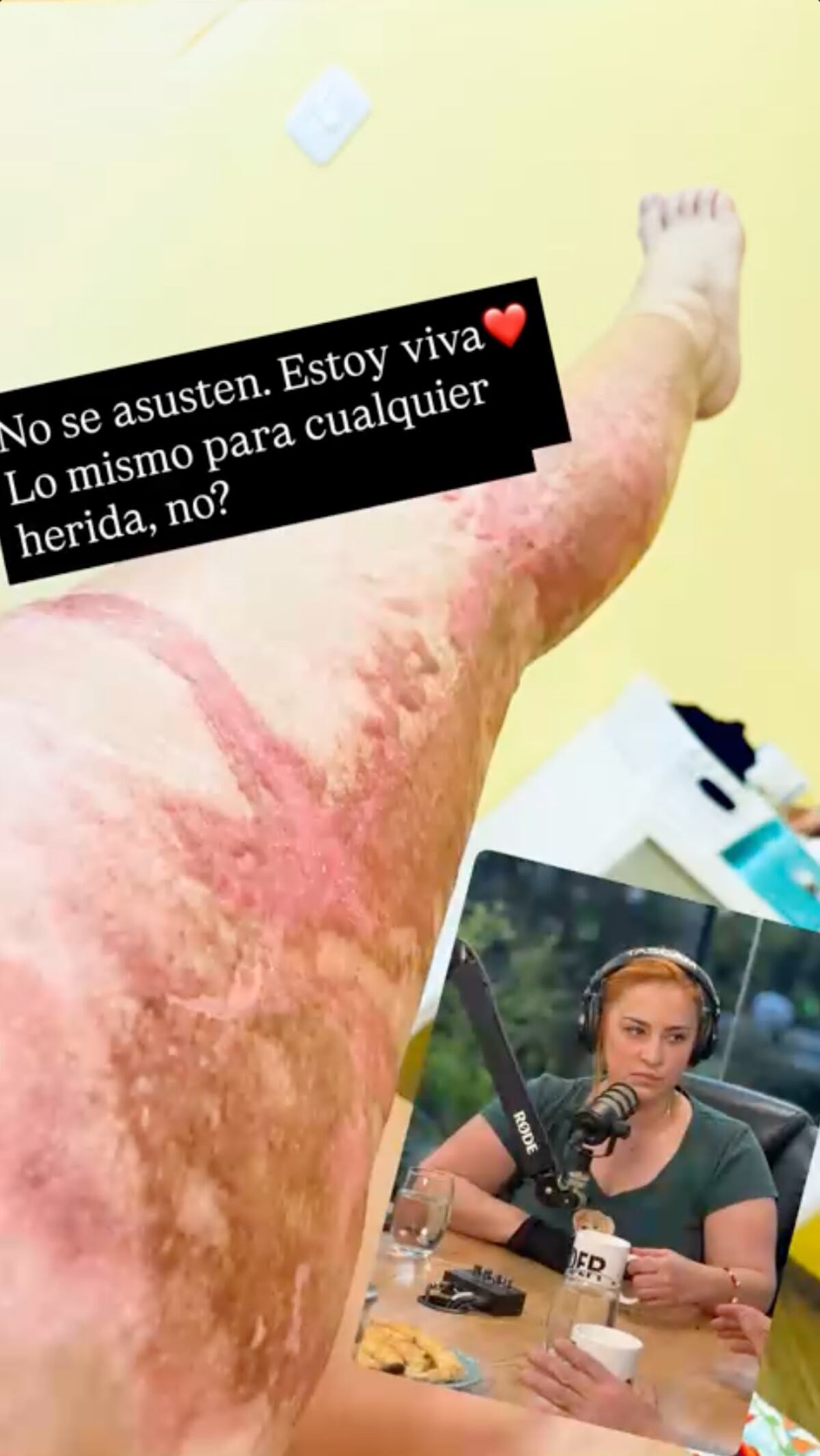 María Julia Oliván mostró cómo quedó su pierna tras el grave accidente doméstico que sufrió hace meses al quemarse con una estufa. (Foto: Instagram)